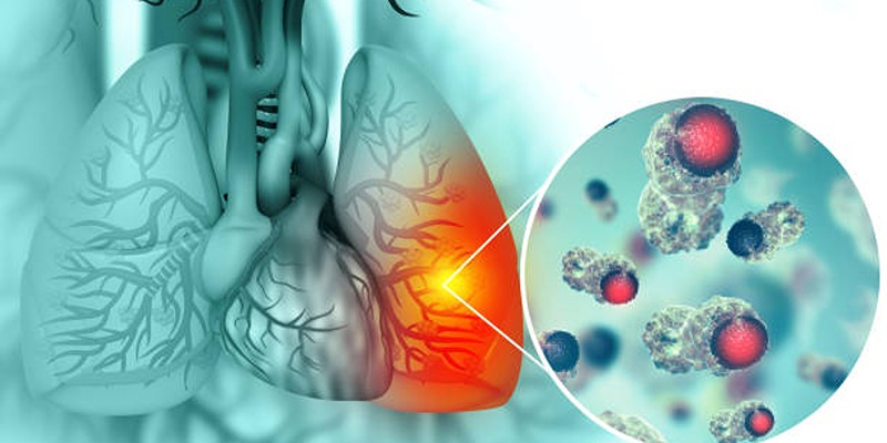 How Genetics and Environment Influence Cystic Fibrosis Risk Factors?