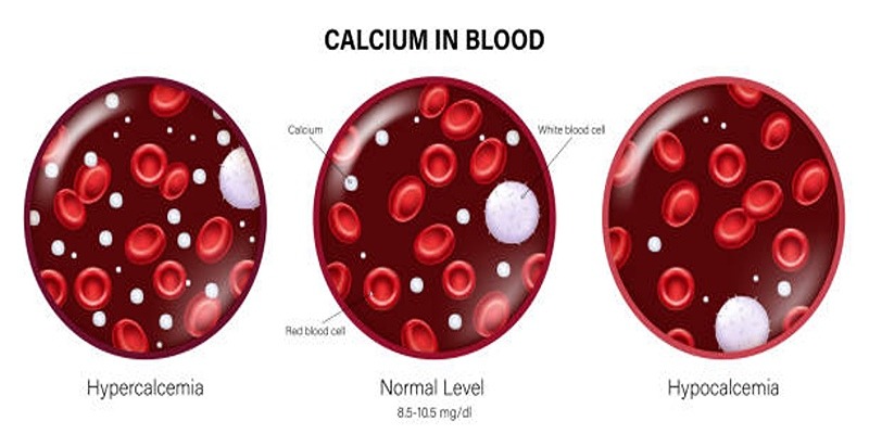 Effective Ways to Treat and Manage Hypocalcemia