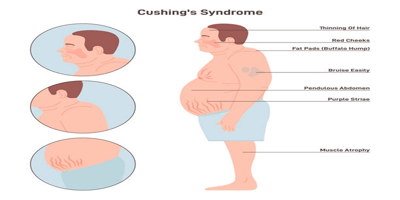 Why Does Cushing's Syndrome Occur? An Informative Look